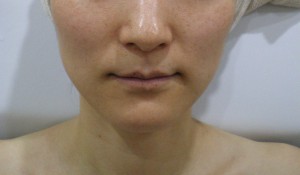 美肌再生プログラムのビフォーアフター画像